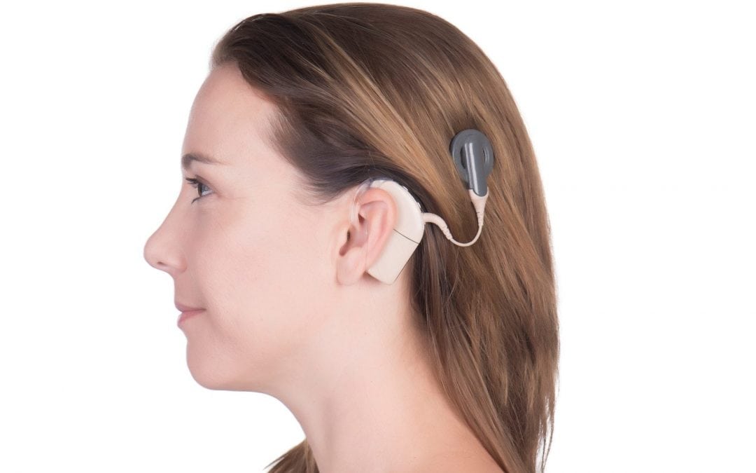 Cochlear Implants